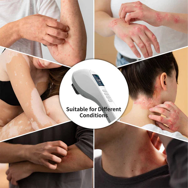 Handheld UVB Phototherapy Device for Vitiligo & Psoriasis - Portable 308nm Light Therapy Lamp by UVBtreatment